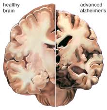 Comparison of healthy vs. alzheimers brain