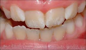 Fluorosis caused by too much flouride